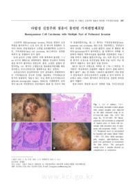 다발성 신경주위 침윤이 동반된 기저편평세포암